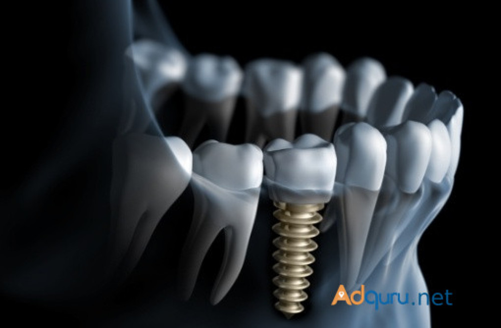 restore-your-smile-with-expert-dental-implants-in-euless-tx-big-0