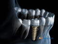 restore-your-smile-with-expert-dental-implants-in-euless-tx-small-0