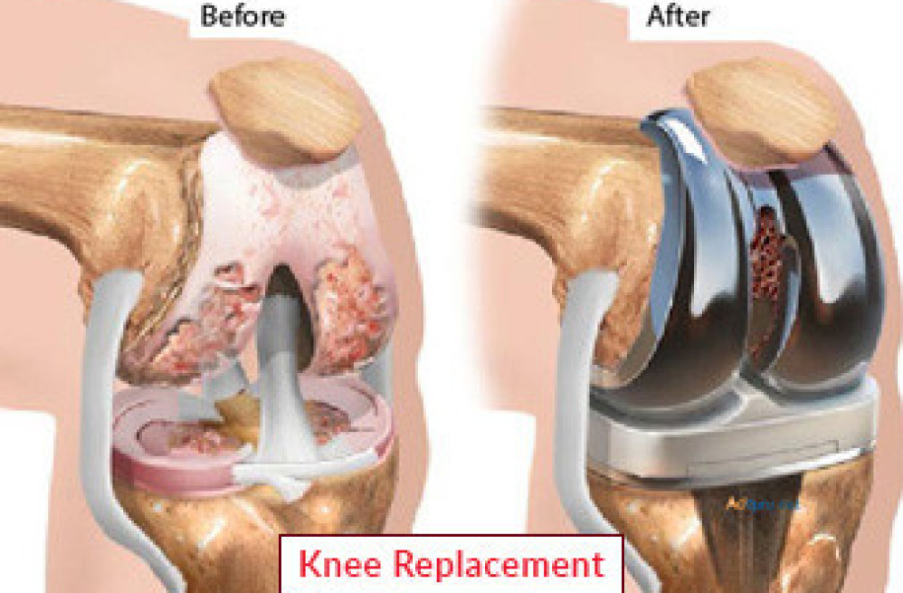 knee-replacement-surgery-a-revolutionary-treatment-for-knee-joint-pain-in-solomon-islands-big-0