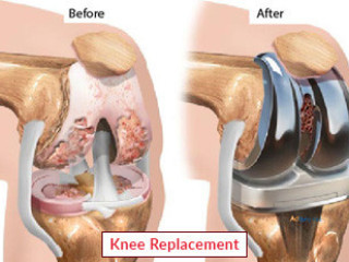 Knee Replacement Surgery: A Revolutionary Treatment for Knee Joint Pain in Solomon Islands