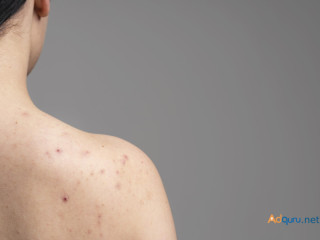 How to Cure Chest Acne: Causes and Treatments