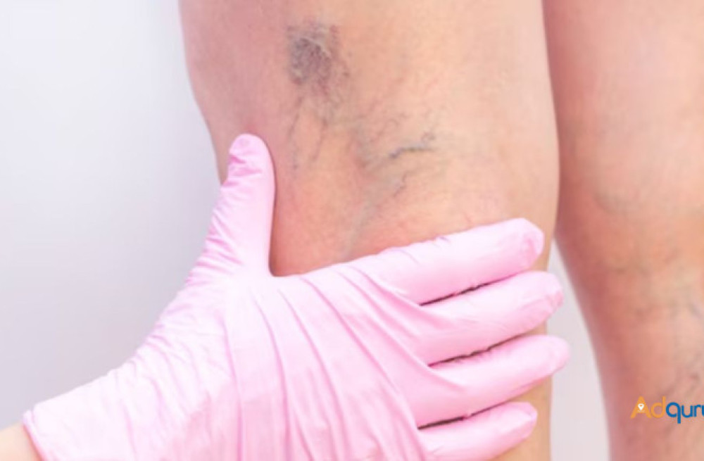 best-spider-vein-treatment-advanced-medical-group-big-0