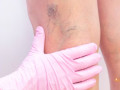 best-spider-vein-treatment-advanced-medical-group-small-0