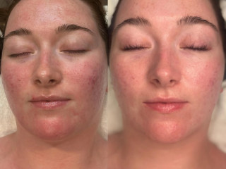 Glass Skin Facial
